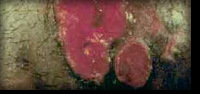 Cancro Mole ou Cancroide