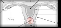 Cervicite Mucopurulenta