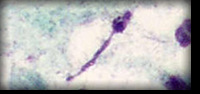 Tricomíase